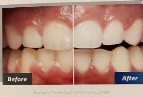 The image shows a before-and-after comparison of a teeth whitening treatment, with the left side displaying discolored teeth and the right side showing significantly brighter, cleaner teeth after the procedure.