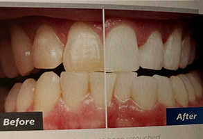 The image shows a side-by-side comparison of a person s teeth before and after dental treatment, highlighting the improvement achieved by the procedure.