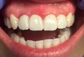 The image displays a close-up view of a person s mouth with teeth, showing an upper and lower set of dentures with visible wear and staining, against a background that seems to be clinical or medical due to the presence of blue gloves and a medical mask.