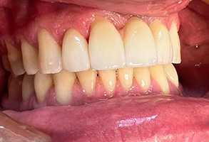 The image shows a close-up of a person s mouth with teeth that have been whitened, likely through cosmetic dental procedures.