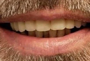 The image shows a close-up of a person with a mustache smiling at the camera, displaying a set of teeth with one tooth missing.