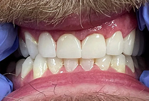 The image features a close-up view of an individual s teeth with a blue surgical drape over their nose, showcasing a smile with a full set of yellowed teeth and a mustache.