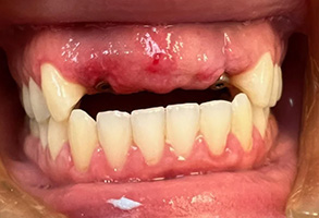 The image shows a close-up of a mouth with yellowed teeth, gum inflammation, and an unhealthy appearance, which suggests poor dental hygiene or health issues.