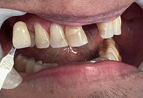 The image depicts a person with an open mouth showing teeth, likely from a dental examination or procedure.