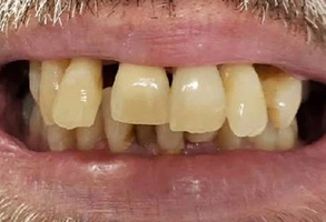 The image shows a close-up of a person s mouth with severely decayed teeth, exhibiting discoloration and damage, against a background that appears to be a webpage.