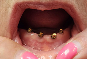 The image features a close-up of a person s open mouth displaying gold teeth, with an additional text overlay on the right side showing a person s hand holding a toothpick with gold studs in their mouth.