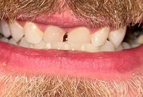 The image shows a close-up of a person s mouth with teeth and lips visible, against a background that appears to be a blurred photograph of a man with facial hair.