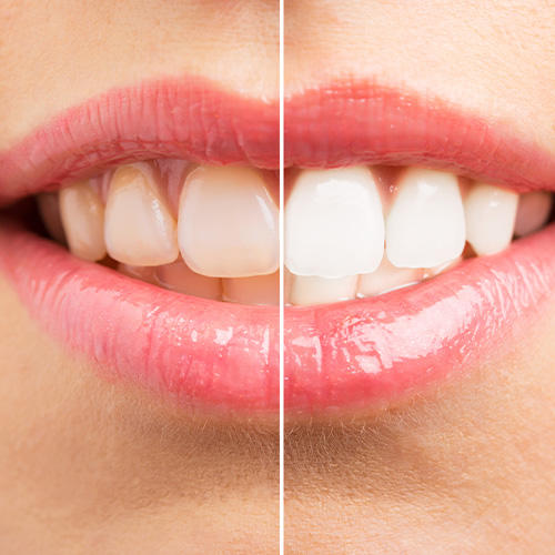The image shows a side-by-side comparison of a person s teeth before and after dental treatment, with the left side showing yellowed teeth and the right side displaying a smile with clean, white teeth.
