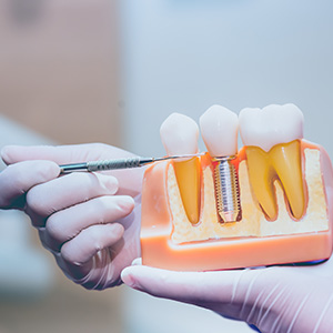 Nova Dental | Pediatric Dentistry, Ceramic Crowns and Dental Cleanings