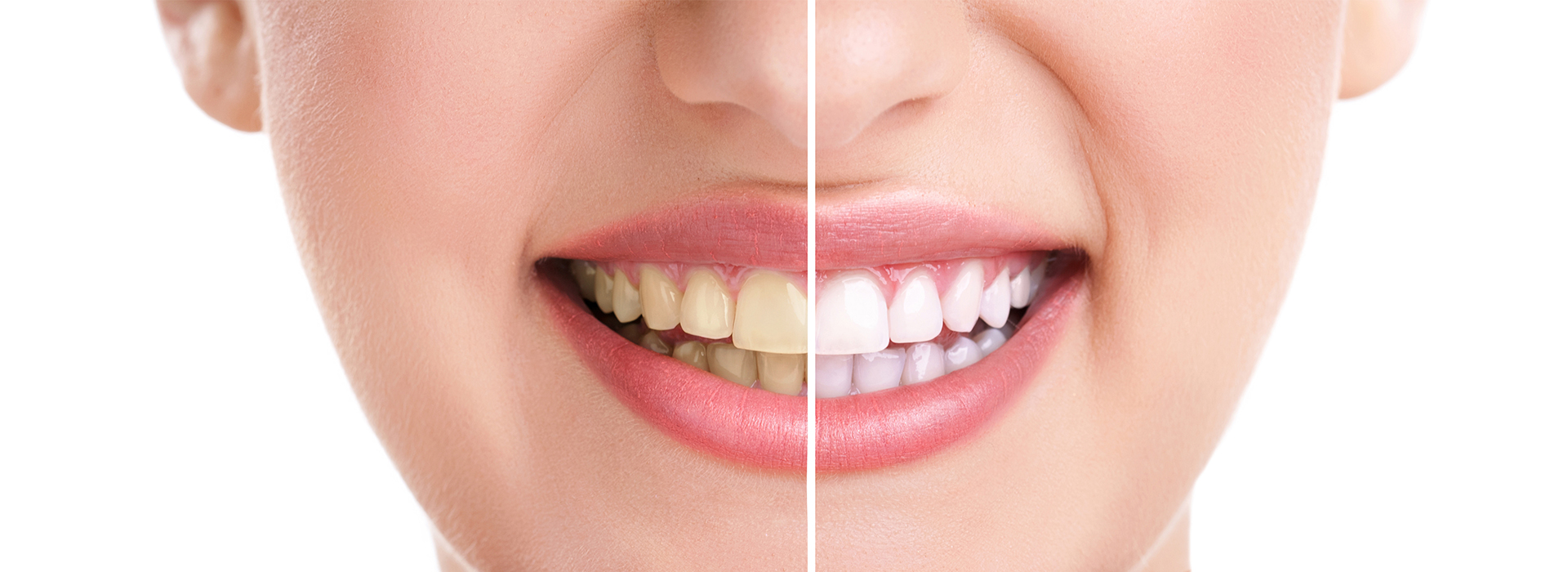 Nova Dental | Dental Sealants, Preventative Program and Sports Mouthguards