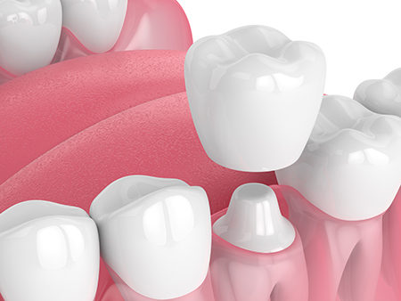 The image displays a collection of artificial teeth with pink gums, arranged in a row against a white background.