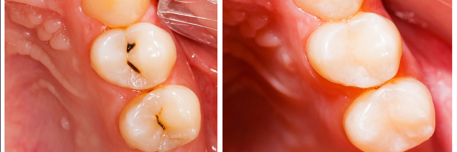 The image displays a close-up view of a dental implant with a pink gumline surrounding it, showing a detailed representation of a tooth root and surrounding tissue.